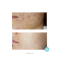 TCA 15% Gel Peel - Level 2 Enhanced with salicylic acid - pH 1.7-2.0